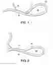 Fig. 02 - Systems for locking a cinch loop in tissue repair