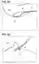 Fig. 20 - Systems for locking a cinch loop in tissue repair