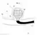 Fig. 02 - Aneurysm device and delivery method