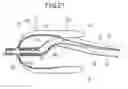 Fig. 22 - Suction catheter, suction system, and treatment method