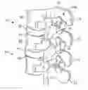 Fig. 01 - Intervertebral implant devices and methods for insertion thereof