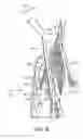 Fig. 06 - Zygomatic elevator device and methods