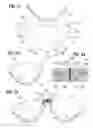 Fig. 08 - Prosthetic heart valve