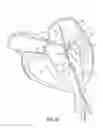 Fig. 02 - Valve docking devices, systems and methods