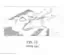 Fig. 06 - Method for performing single-stage cranioplasty reconstruction with a clear custom craniofacial implant