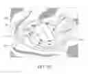 Fig. 22 - Method for performing single-stage cranioplasty reconstruction with a clear custom craniofacial implant