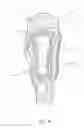 Fig. 07 - Disarticulated Compression Socket