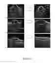 Fig. 20 - POWDER FORM AND USE OF HYDROGEL COMPOSITIONS FOR ALLEVIATING DEGENERATIVE JOINT AND TENDON TEAR