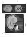 Fig. 04 - Methods, apparatuses, and systems for creating 3-dimensional representations exhibiting geometric and surface characteristics of brain lesions