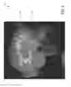 Fig. 05 - Methods, apparatuses, and systems for creating 3-dimensional representations exhibiting geometric and surface characteristics of brain lesions