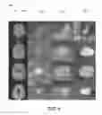 Fig. 07 - Methods, apparatuses, and systems for creating 3-dimensional representations exhibiting geometric and surface characteristics of brain lesions