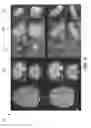 Fig. 09 - Methods, apparatuses, and systems for creating 3-dimensional representations exhibiting geometric and surface characteristics of brain lesions
