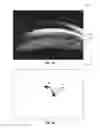 Fig. 07 - PATTERNED BEAM ANALYSIS OF IRIDOCORNEAL ANGLE