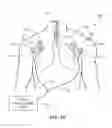 Fig. 02 - System for positioning an intubation tube