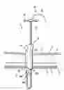 Fig. 01 - Surgical port closure system