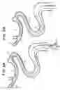 Fig. 03 - System for removing a clot from a blood vessel