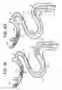 Fig. 04 - System for removing a clot from a blood vessel