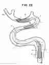 Fig. 05 - System for removing a clot from a blood vessel
