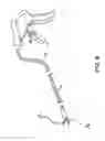 Fig. 09 - Medical device to remove an obstruction from a body lumen, vessel or organ