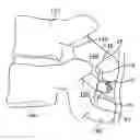 Fig. 01 - Interspinous spacer
