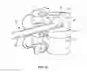 Fig. 07 - Scoop cannula with deflectable wings