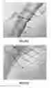 Fig. 43 - Methods, apparatuses, and systems for the treatment of pulmonary disorders