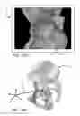 Fig. 20 - Systems and methods for intra-operative pelvic registration