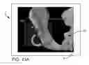 Fig. 22 - Systems and methods for intra-operative pelvic registration