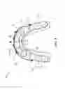 Fig. 09 - Orthodontic space closure device
