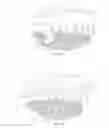 Fig. 04 - Positioning handle and occlusal locks for removable prosthesis