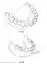 Fig. 07 - Positioning handle and occlusal locks for removable prosthesis