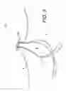 Fig. 04 - Adjustable suture button construct