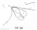 Fig. 08 - Adjustable suture button construct