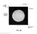 Fig. 07 - Intraocular lens visualization and tracking system