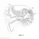 Fig. 02 - Passive middle ear prosthesis