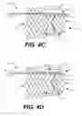 Fig. 06 - Paravalvular leak occlusion device for self-expanding heart valves