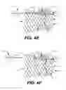 Fig. 07 - Paravalvular leak occlusion device for self-expanding heart valves