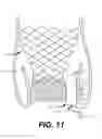 Fig. 14 - Paravalvular leak occlusion device for self-expanding heart valves