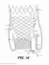 Fig. 17 - Paravalvular leak occlusion device for self-expanding heart valves