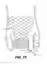 Fig. 18 - Paravalvular leak occlusion device for self-expanding heart valves