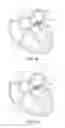 Fig. 16 - System and method for cardiac valve repair and replacement