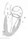 Fig. 01 - Methods for anchoring a device at a native heart valve annulus