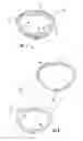 Fig. 02 - Heart valve sizing ring and method