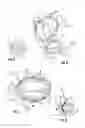 Fig. 03 - Heart valve sizing ring and method