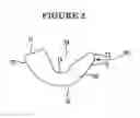 Fig. 03 - PROXIMAL CARPAL ROW IMPLANT