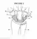Fig. 04 - PROXIMAL CARPAL ROW IMPLANT