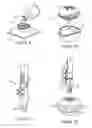 Fig. 04 - Holder for an acetabular cup implant