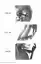 Fig. 15 - Stents having protruding drug-delivery features and associated systems and methods