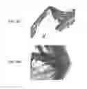 Fig. 16 - Stents having protruding drug-delivery features and associated systems and methods