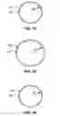 Fig. 03 - STENT DELIVERY SYSTEMS WITH SHAPED EXPANSION BALLOONS